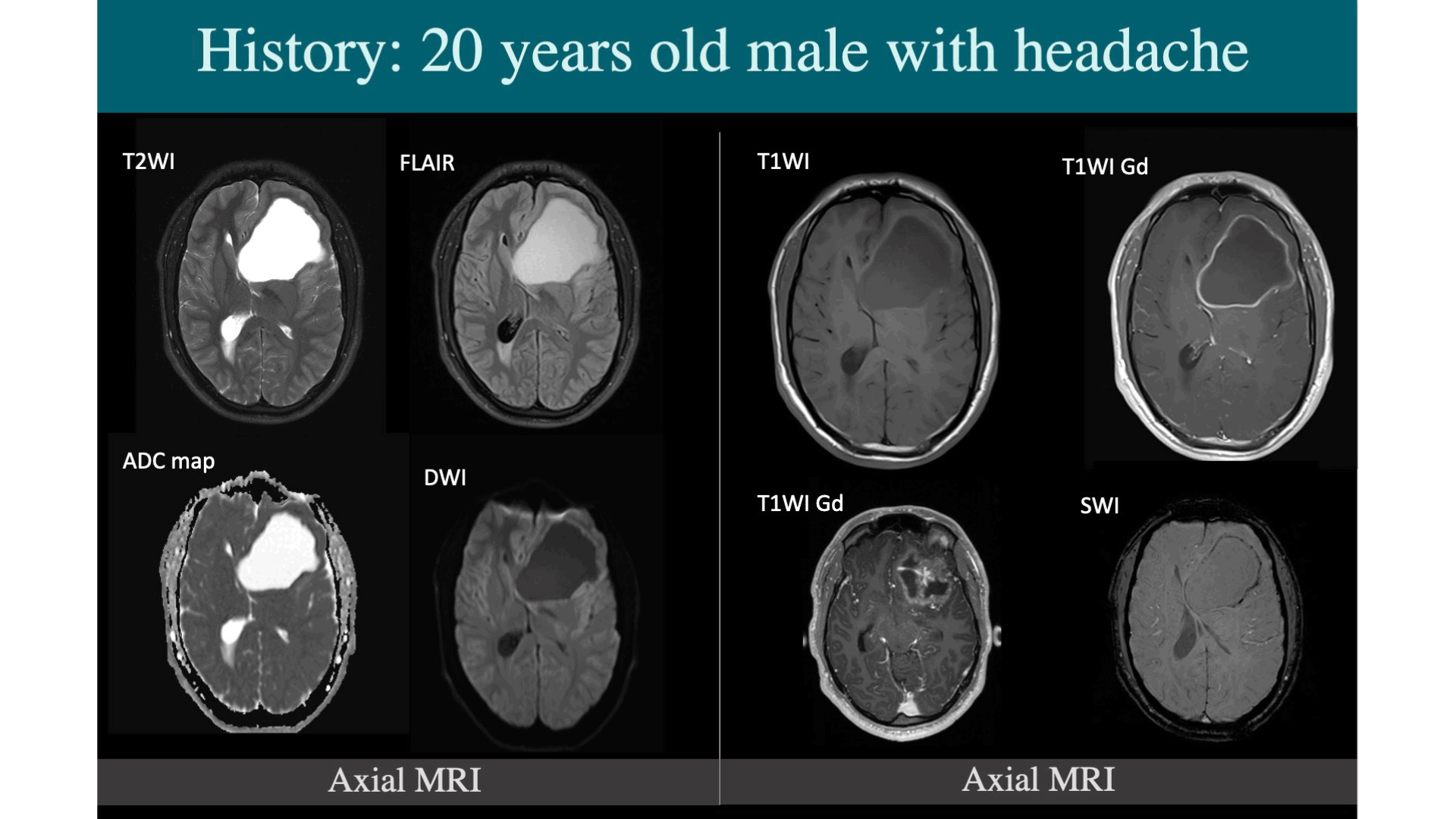 Axial MRI scans of a 20-year-old male with a headache reveal a large, complex mass within the left cerebral hemisphere, causing significant surrounding edema and mass effect. The lesion's core is bright on T2 and FLAIR images, suggesting cystic or necrotic components. Following gadolinium contrast, two T1-weighted slices show thick, irregular peripheral enhancement and some internal nodular enhancement, indicating a heterogeneous tumor. Critically, the mass demonstrates facilitated diffusion (dark on DWI, bright on ADC), a key feature arguing against a pyogenic abscess. Furthermore, the SWI sequence shows multiple dark foci within the enhancing rim, consistent with hemorrhage or calcification. These combined findings are highly suggestive of a complex intra-axial neoplasm, such as a high-grade glioma.